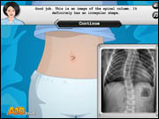 Scoliosis Surgery